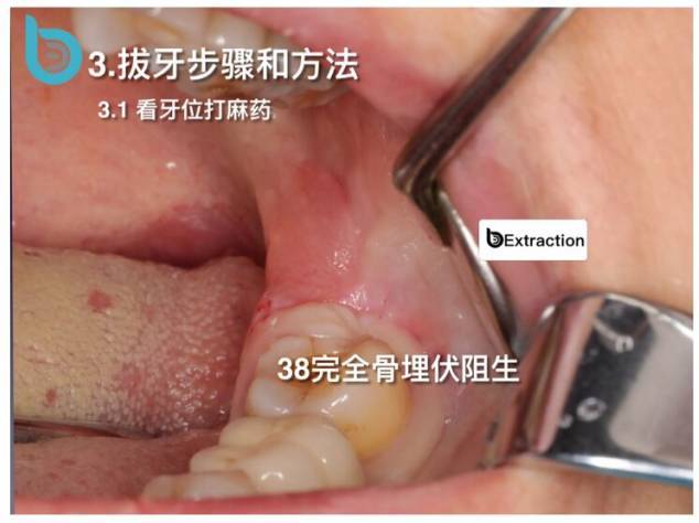 拔下颌智齿舌侧骨板一起拔出
