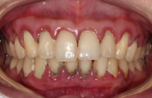 牙齿翻瓣术的利与弊