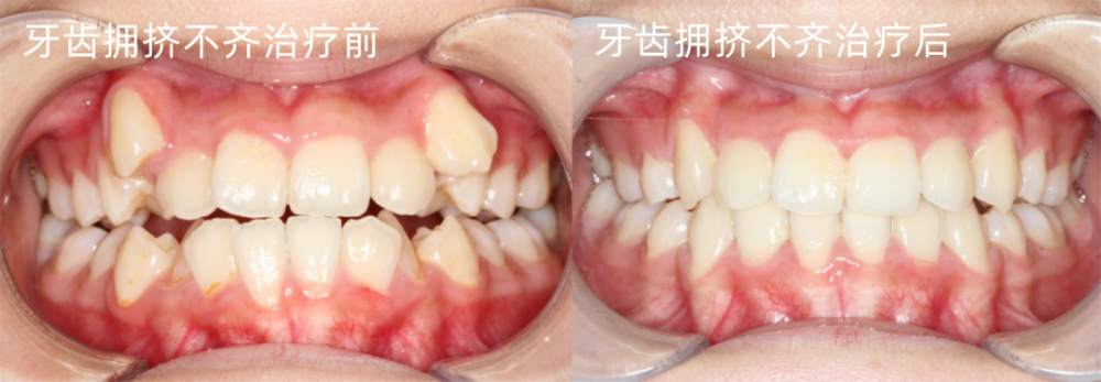 牙齿正畸后,注重牙垫高的重要性