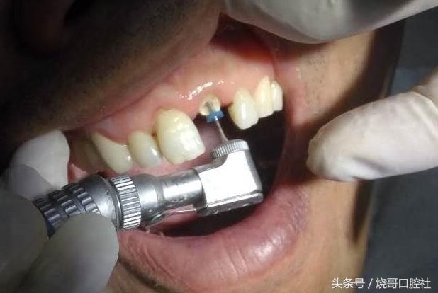 柱冠修复与种植