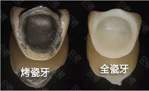 金属牙冠和全瓷牙冠的区别—金属牙冠和全瓷牙冠的区别图片对比