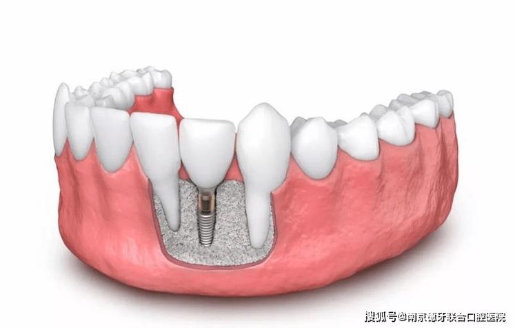 牙龈植骨会有副作用吗