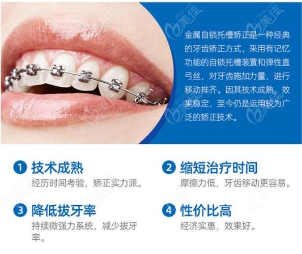 自锁托槽牙套