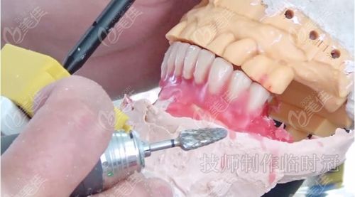 种植牙临时冠牙龈塑形