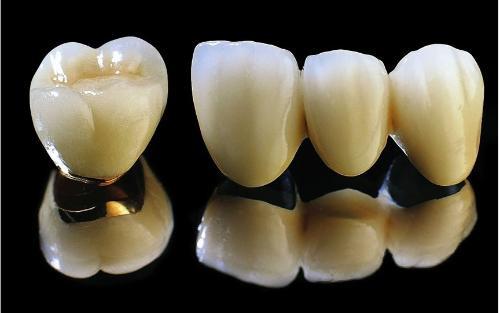 纯钛合金烤瓷牙和3d烤瓷牙的区别