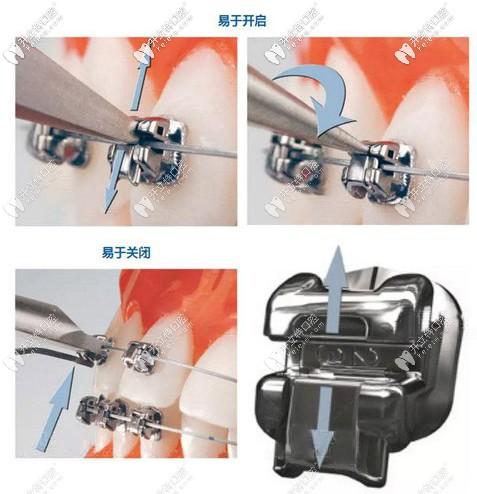 自锁托槽牙套