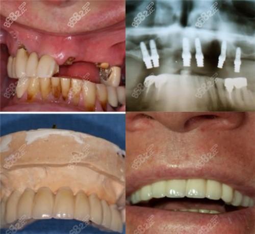 牙齿翻瓣术的利与弊