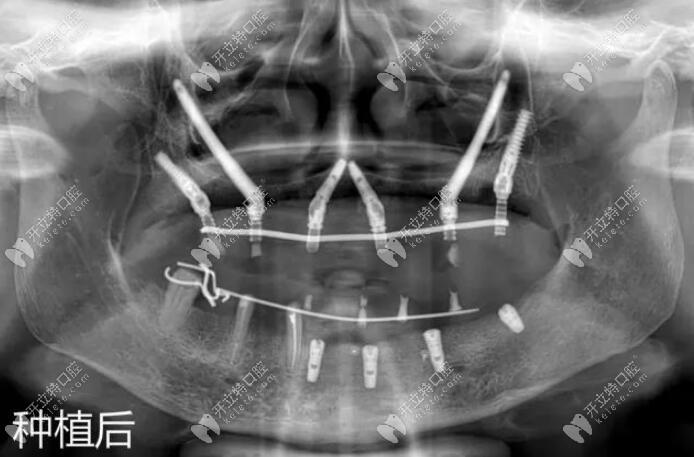 种植牙穿颧有没有后遗症