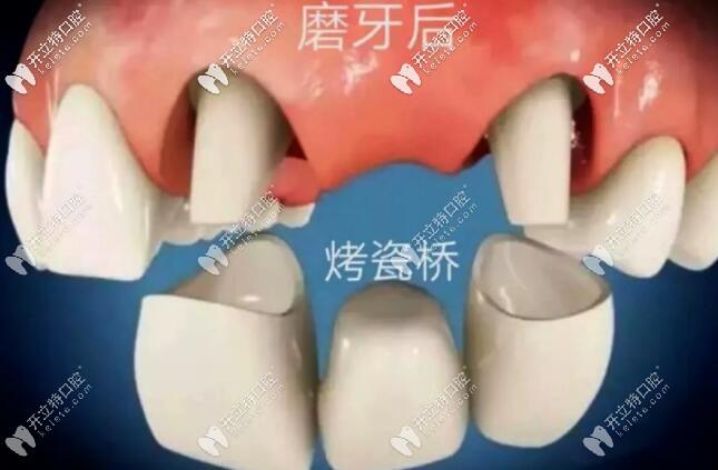 连桥牙冠与牙床间会有缝隙吗