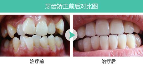 牙齿矫正