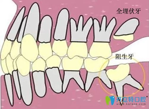 骨性埋藏阻生牙常见吗