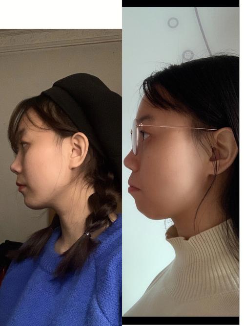 戴牙套后,需要多久才能垫高槽牙