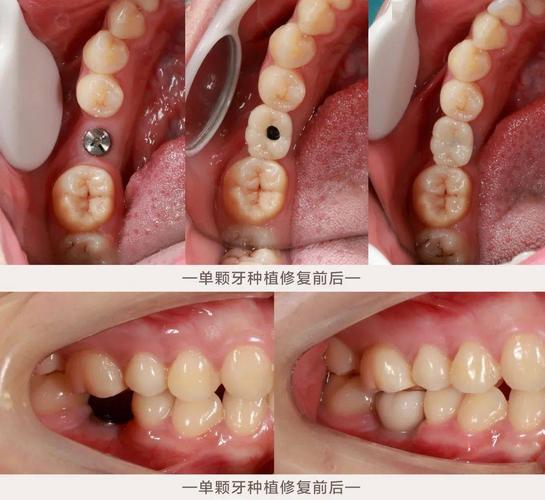 半口活动假牙
