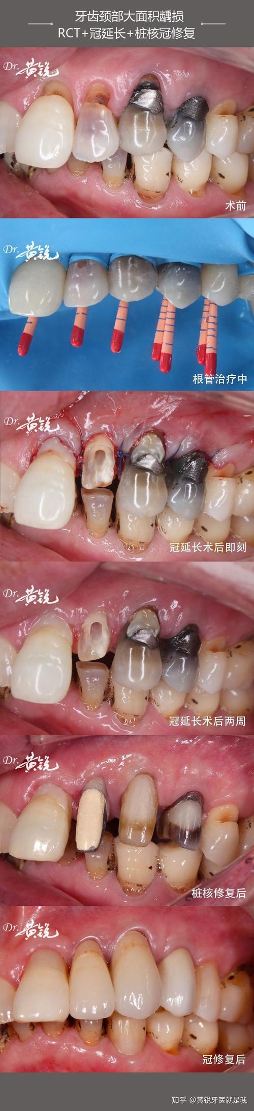 柱冠修复与种植