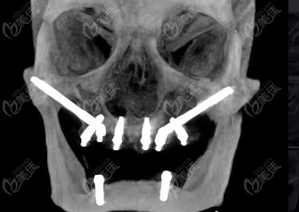 种植牙穿颧有没有后遗症
