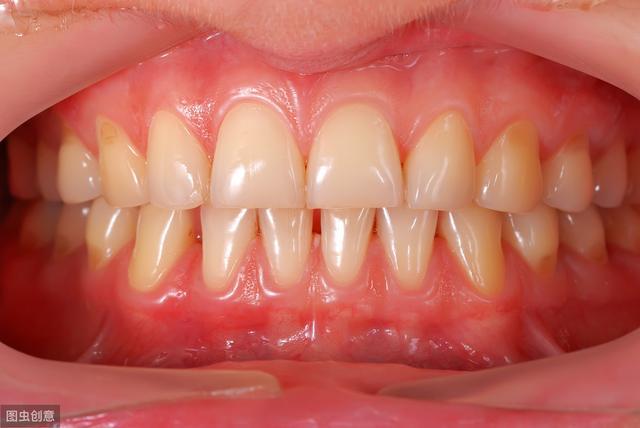 牙龈萎缩可以补牙缝吗—牙龈萎缩能修补填充吗