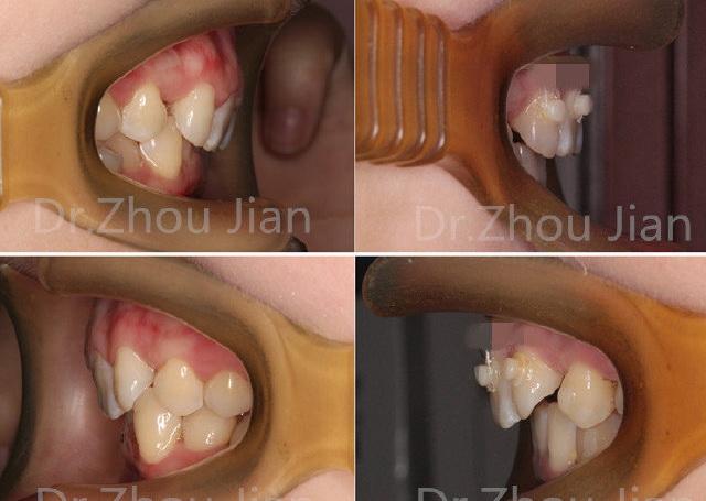 矫正牙齿弓不正的危害