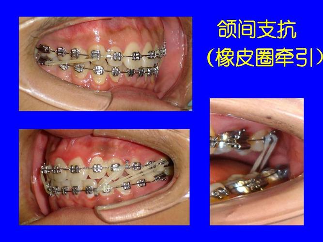 正畸牵引断根原理