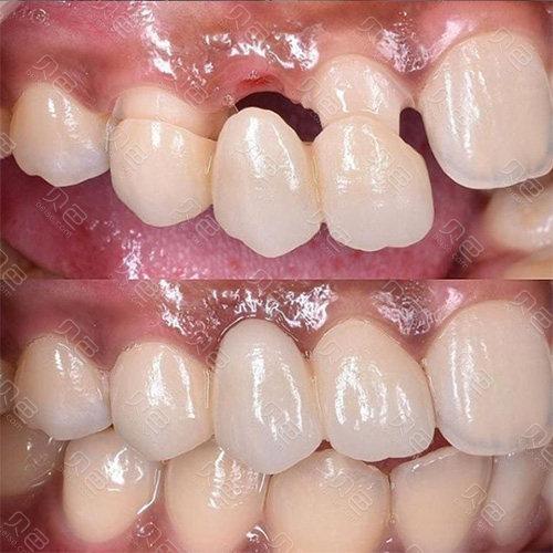 连桥牙冠怎么拆除