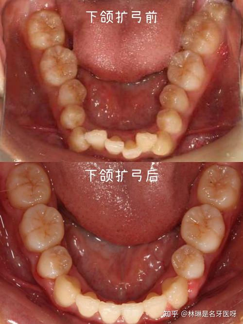 矫正牙齿扩弓的利弊