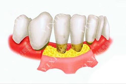 牙龈植骨会有副作用吗