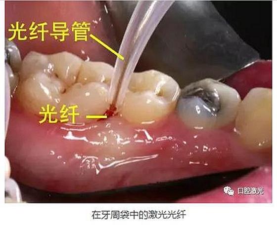 激光切除牙龈增生疼吗