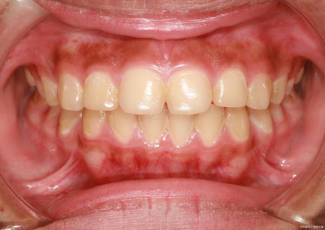 牙龈萎缩可以补牙缝吗—牙龈萎缩能修补填充吗